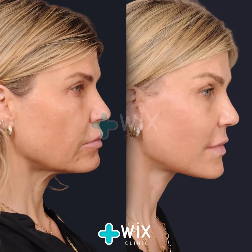 Neck Liposuction Before and After