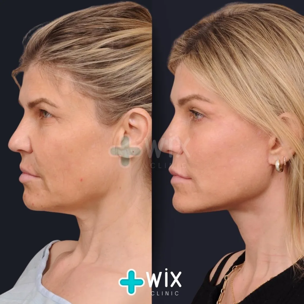 Neck Liposuction Before and After