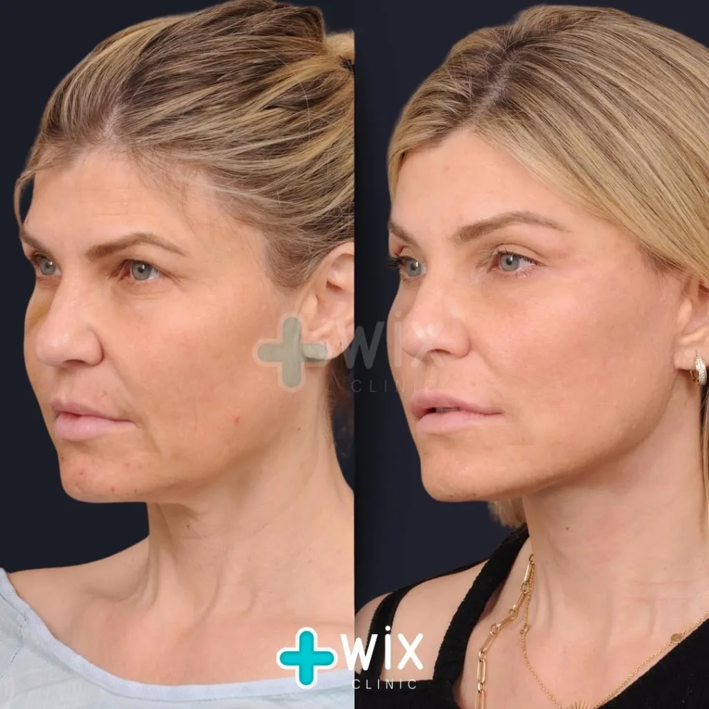 Neck Liposuction Before and After