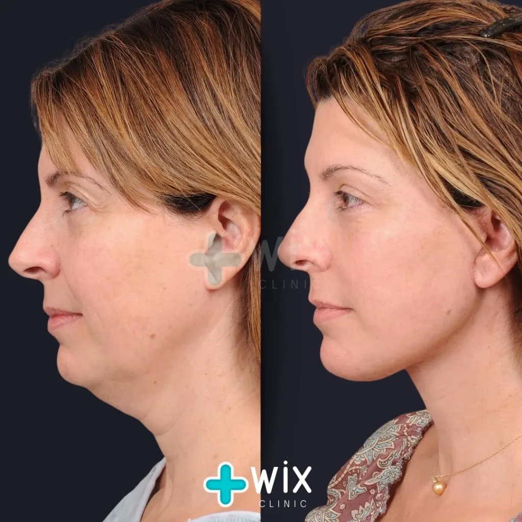 Neck Liposuction Before and After