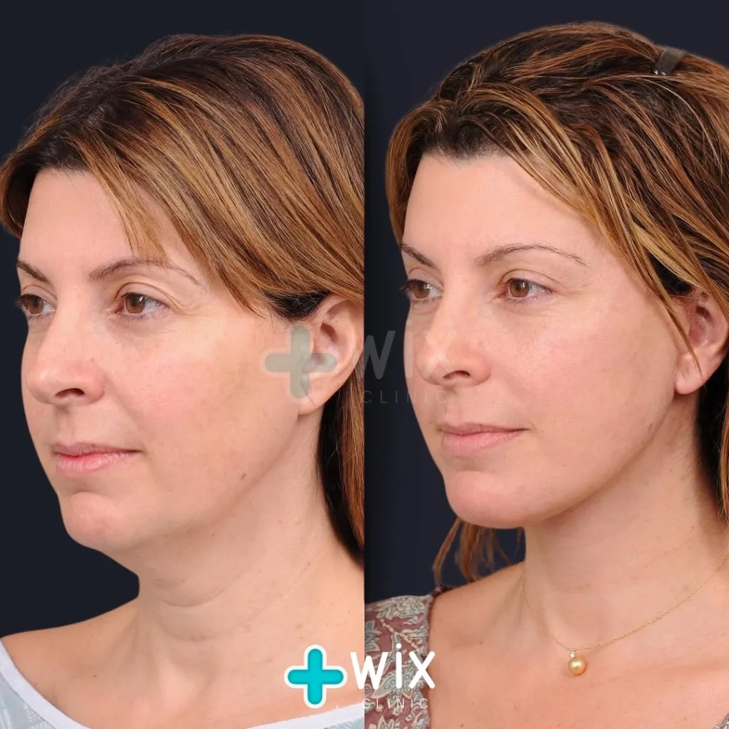 Neck Liposuction Before and After