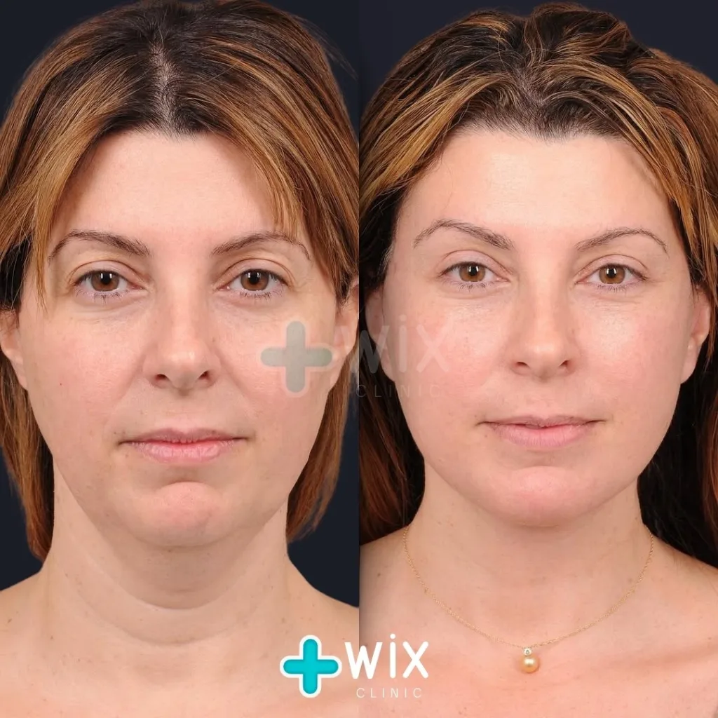 Neck Liposuction Before and After