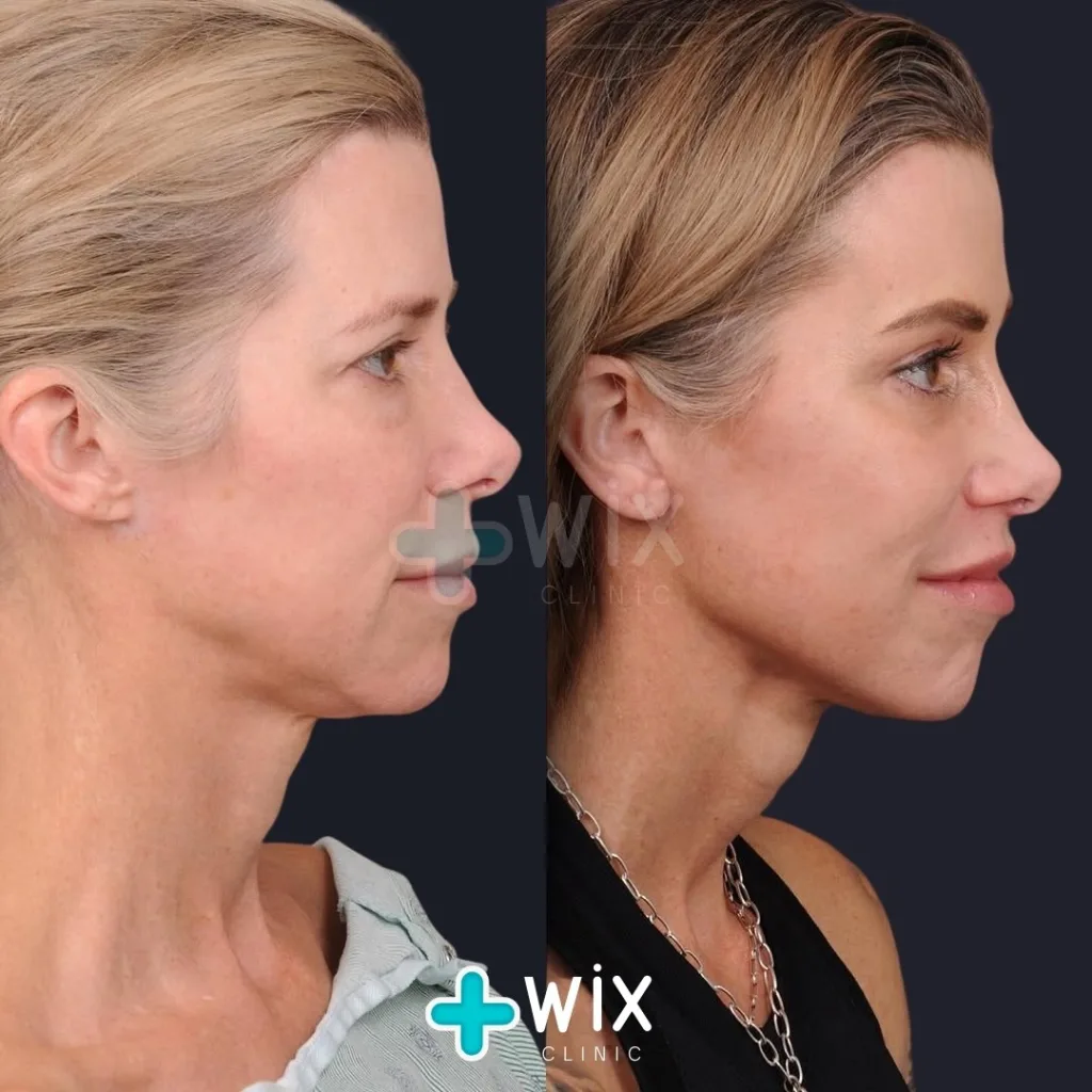 Neck Liposuction Before and After