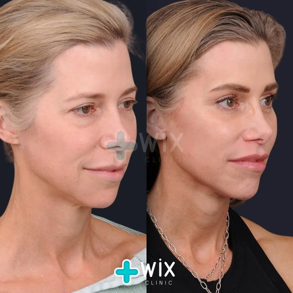 Neck Liposuction Before and After