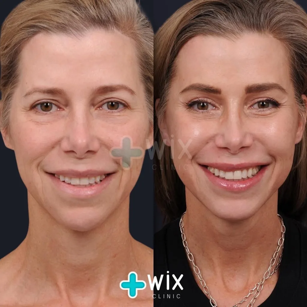 Neck Liposuction Before and After