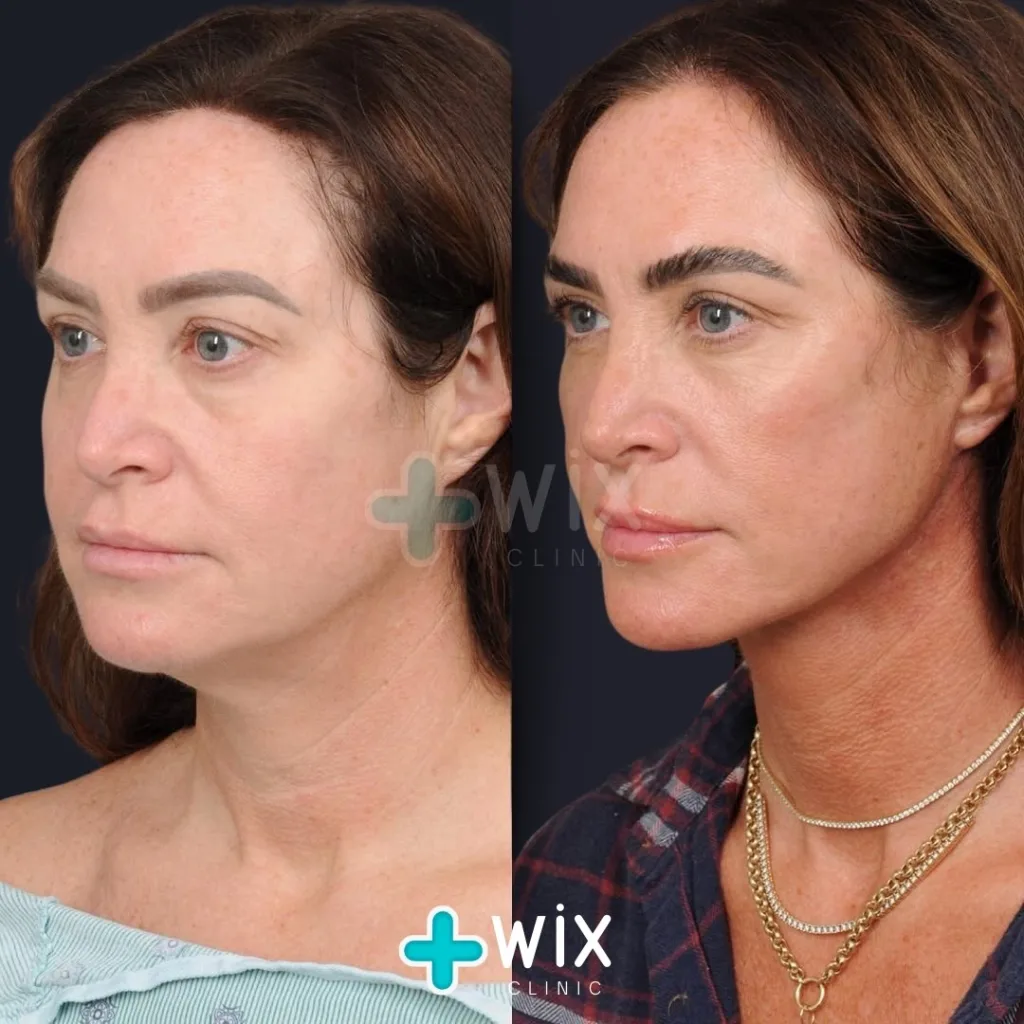 Neck Liposuction Before and After