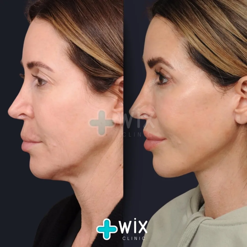 Neck Liposuction Before and After