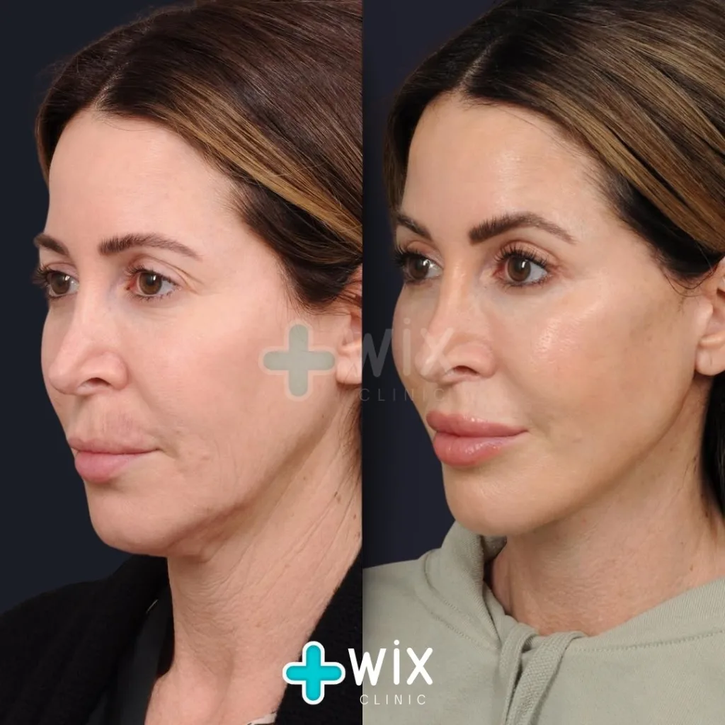 Neck Liposuction Before and After