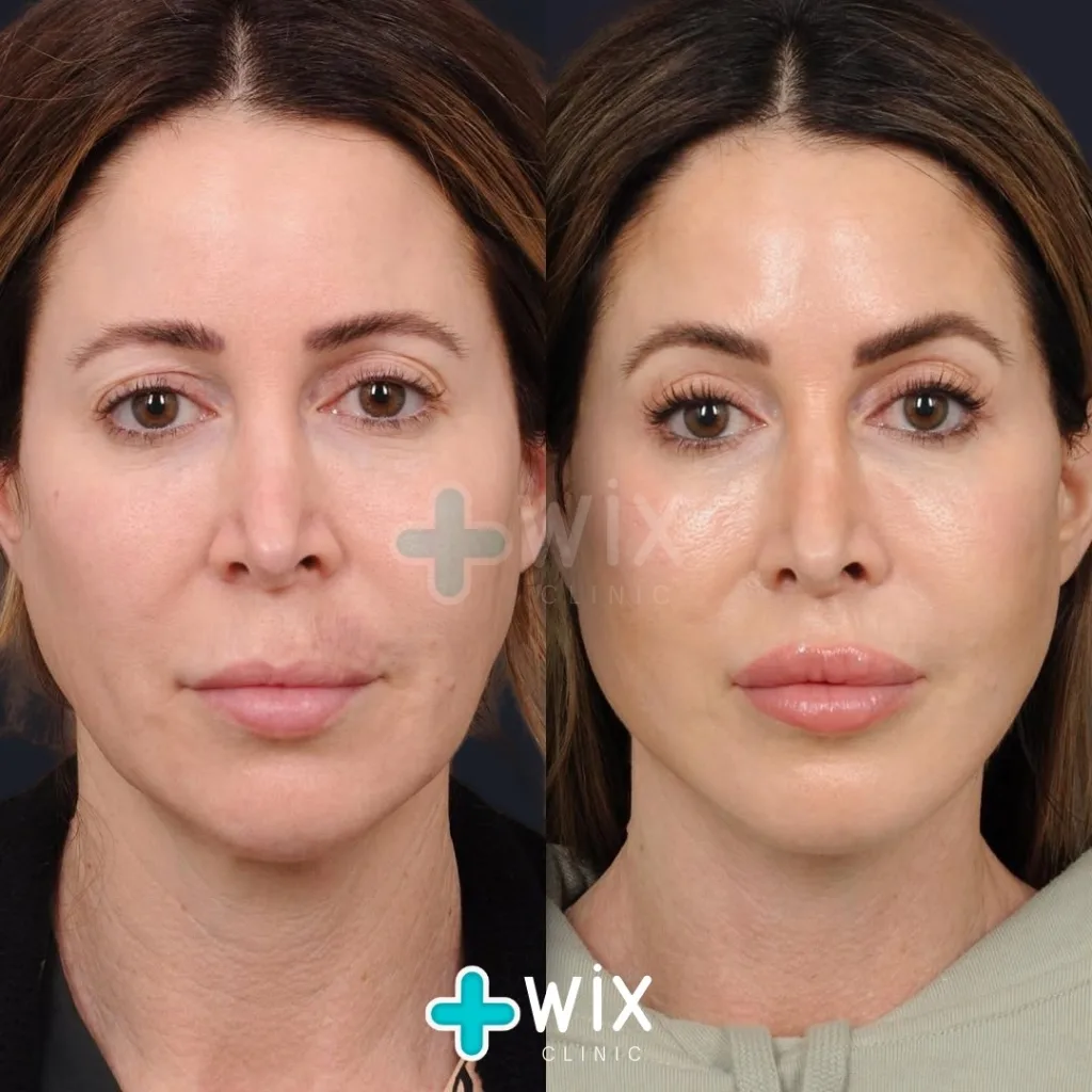 Neck Liposuction Before and After