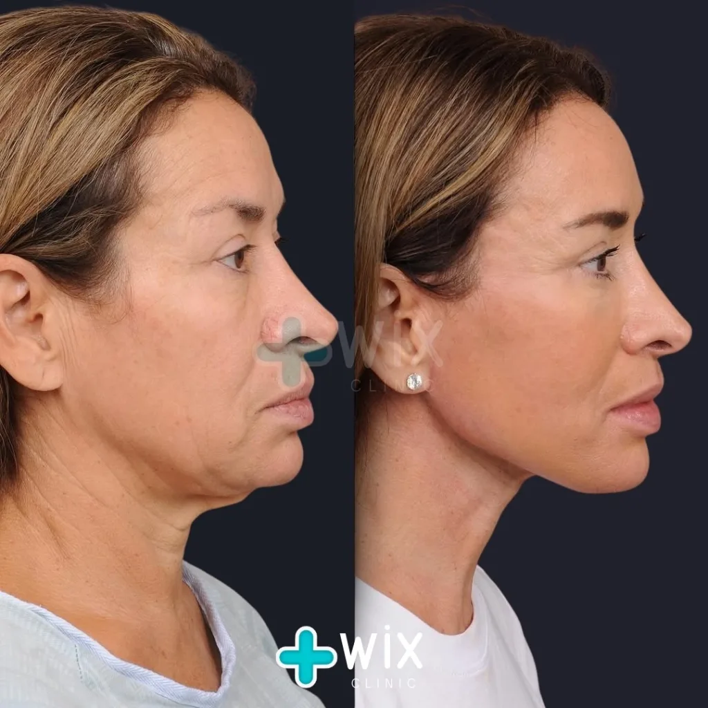 Necklift before and after