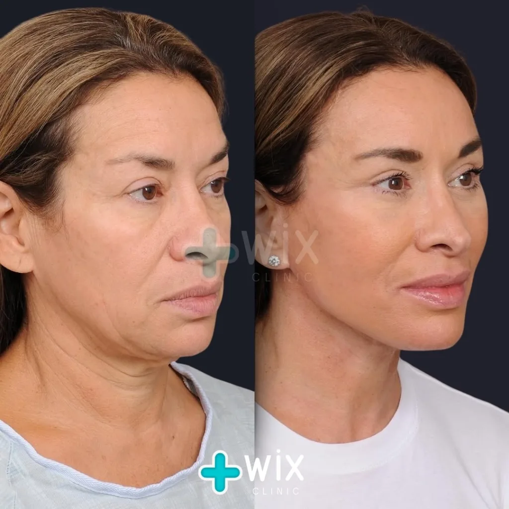 Necklift before and after