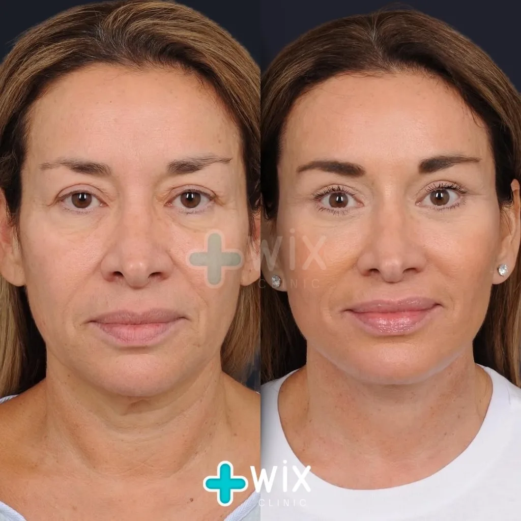 Necklift before and after