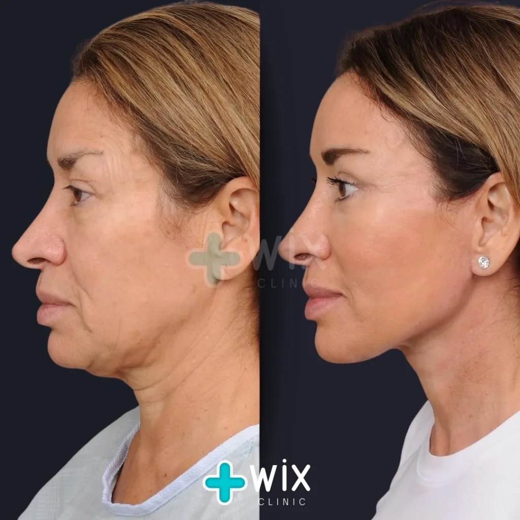 Necklift before and after