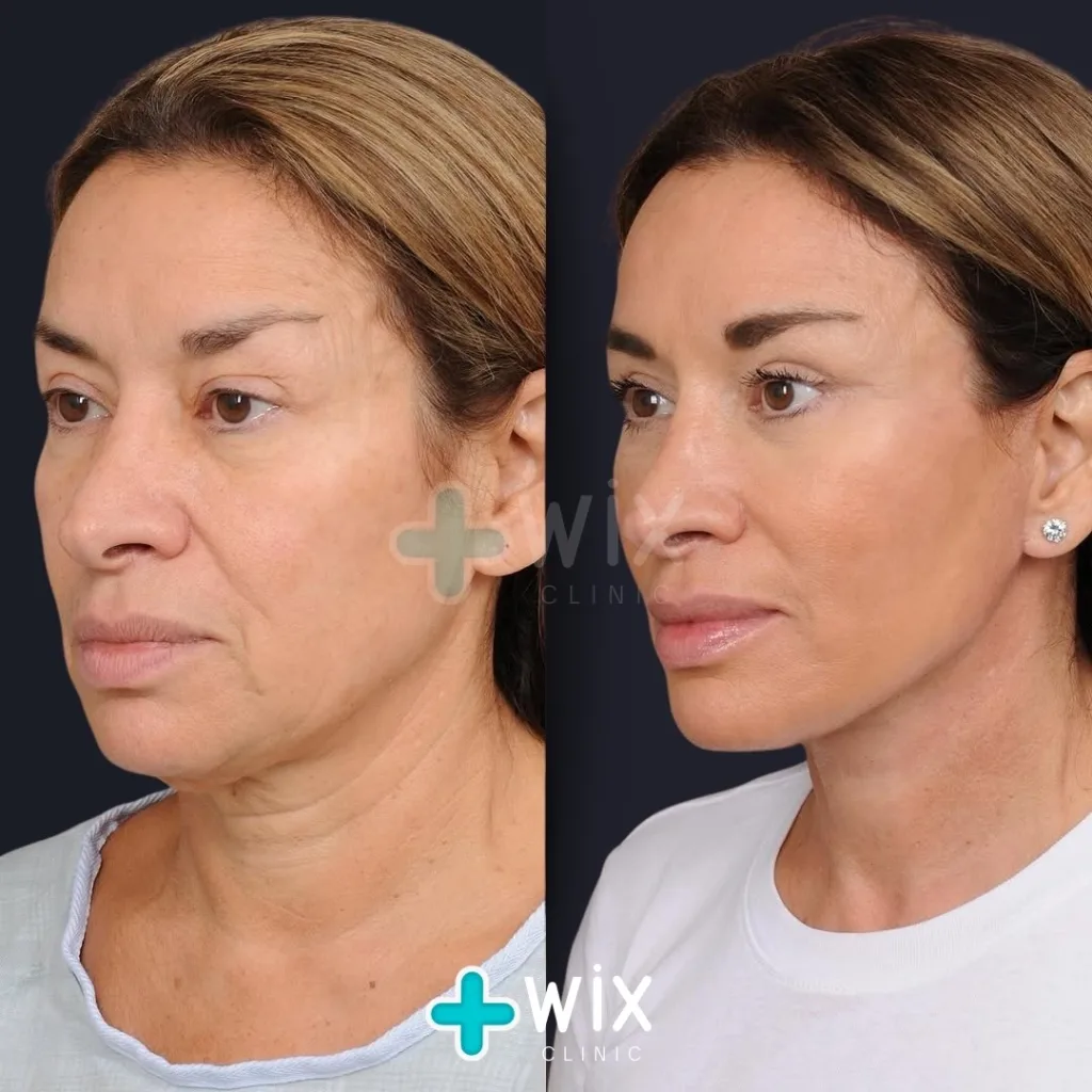 Necklift before and after