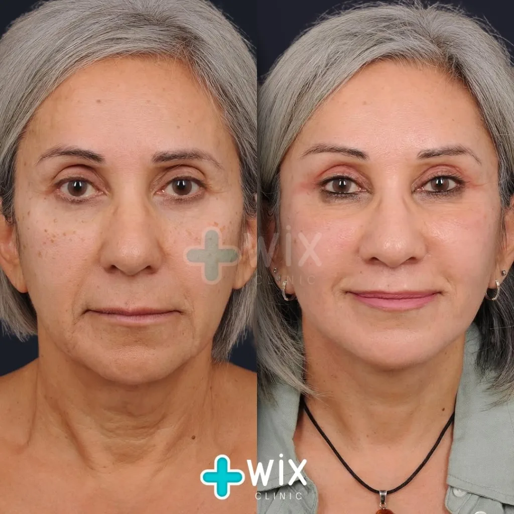 Necklift before and after