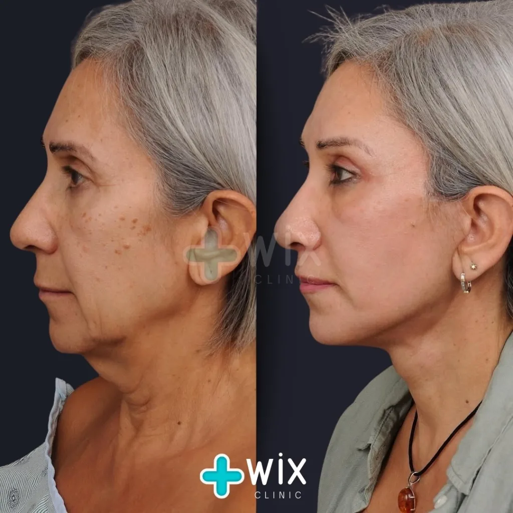 Necklift before and after