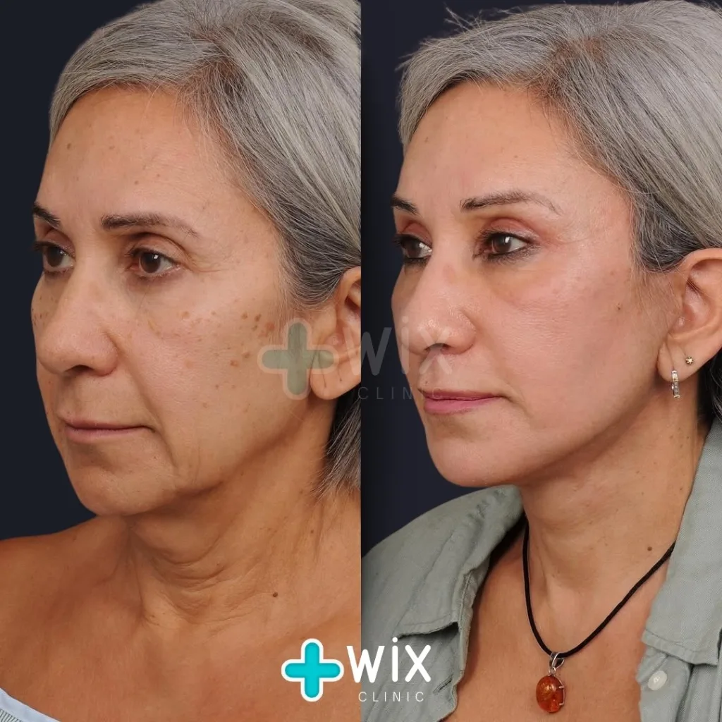 Necklift before and after