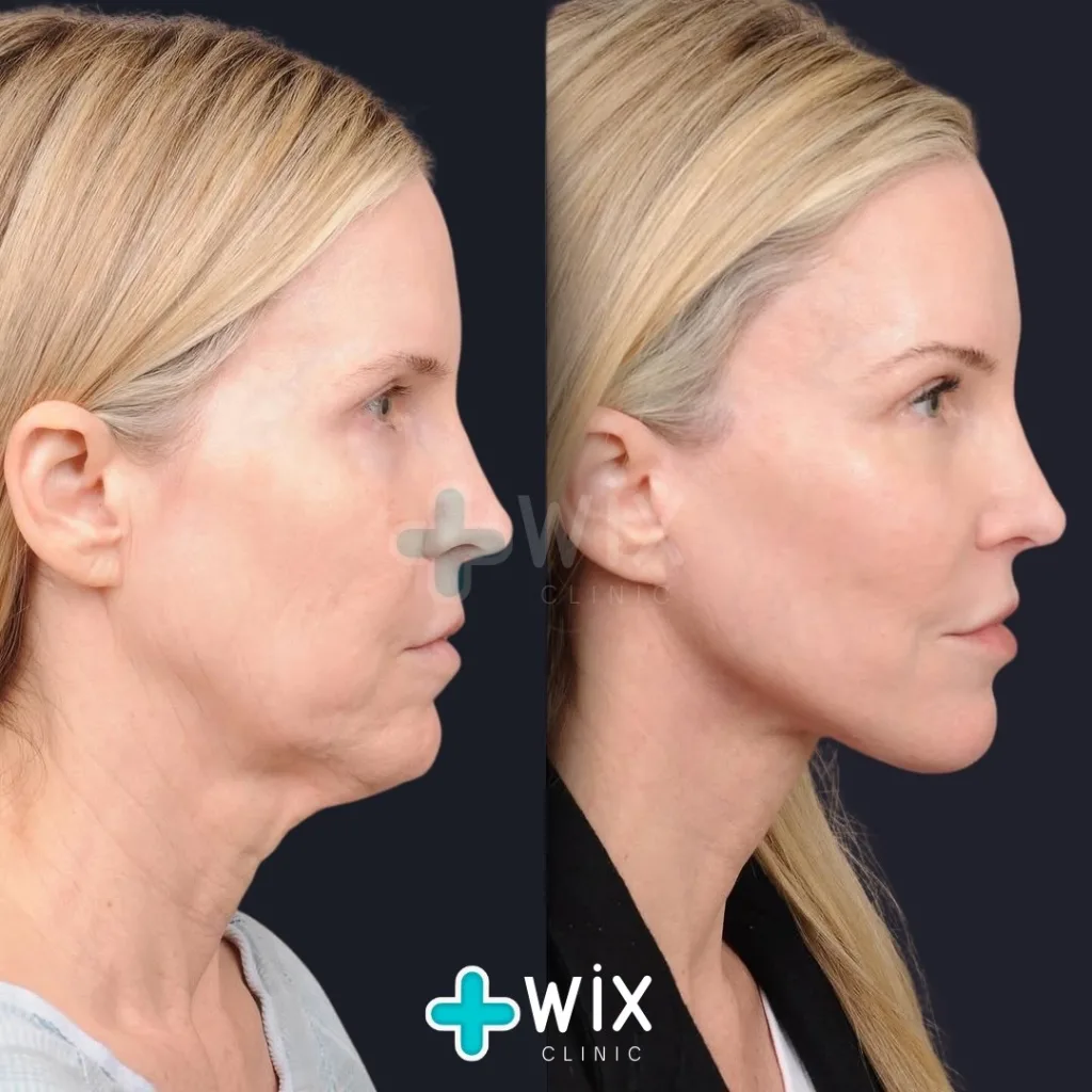 Necklift before and after