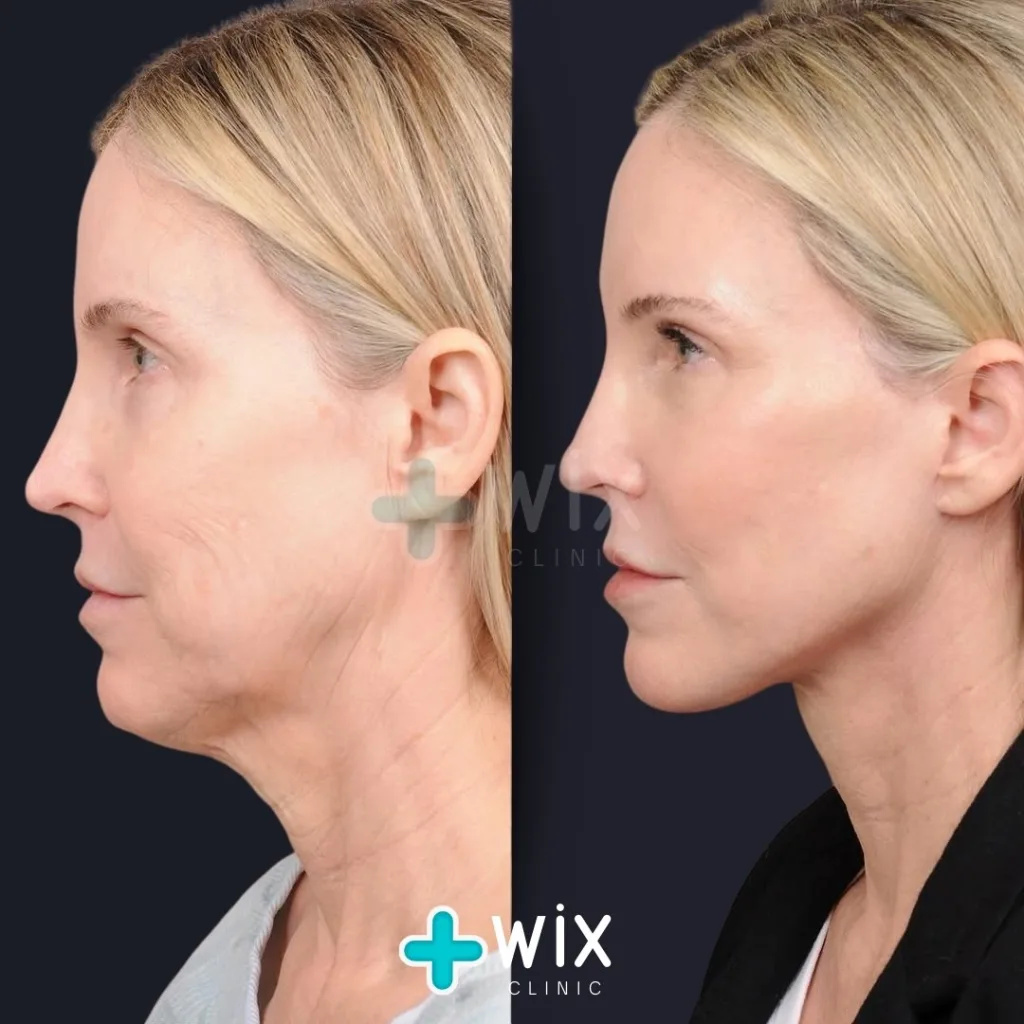 Necklift before and after