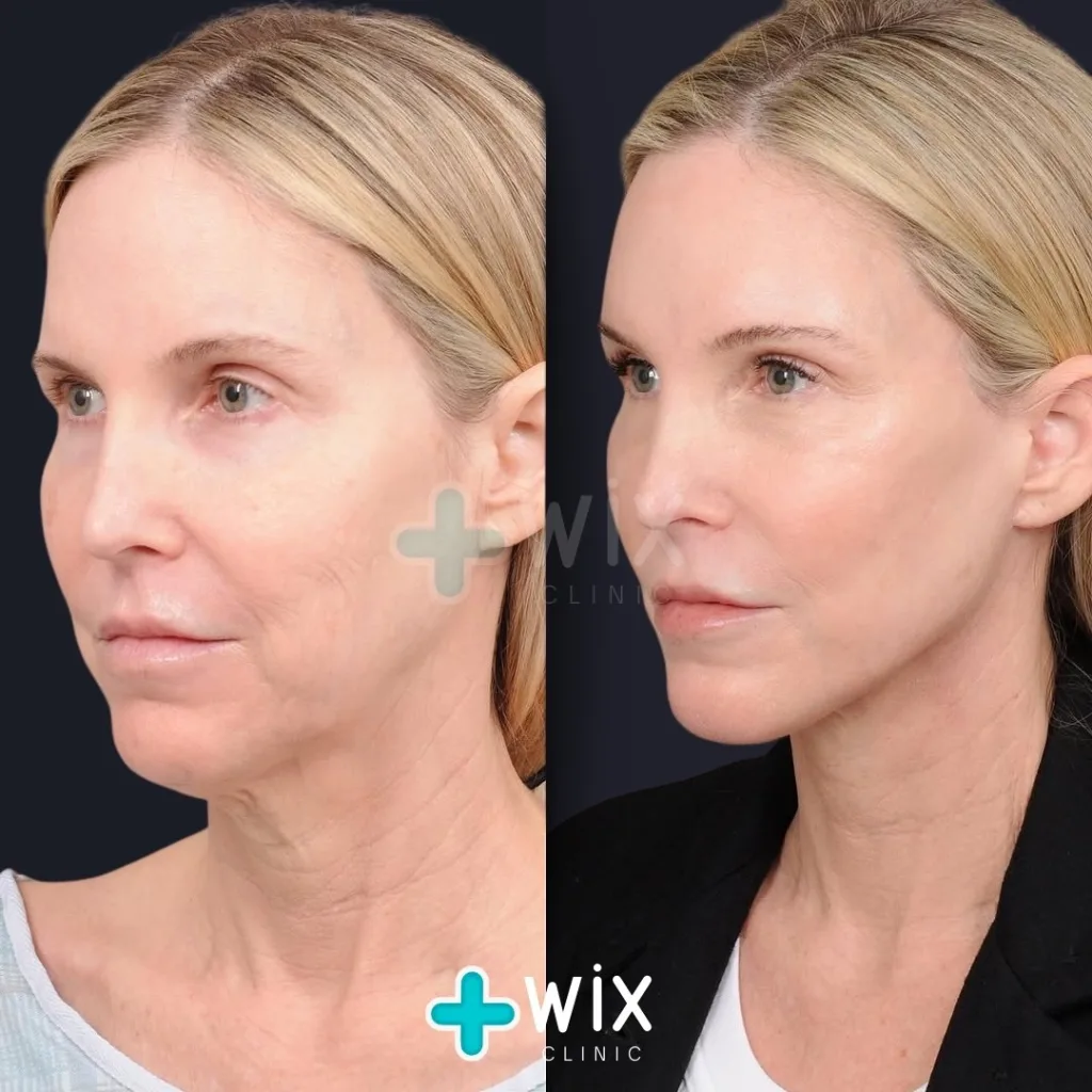 Necklift before and after