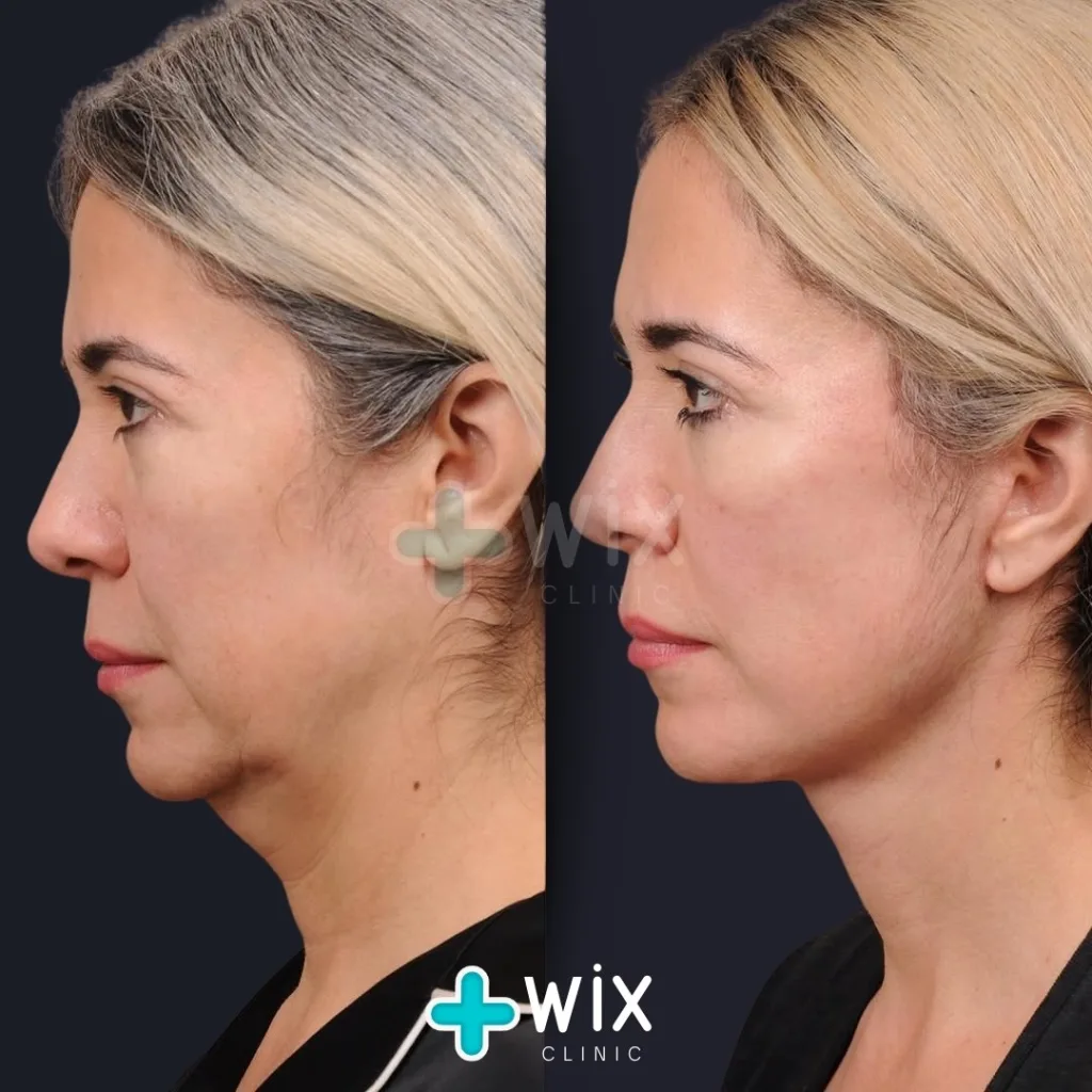 Necklift before and after