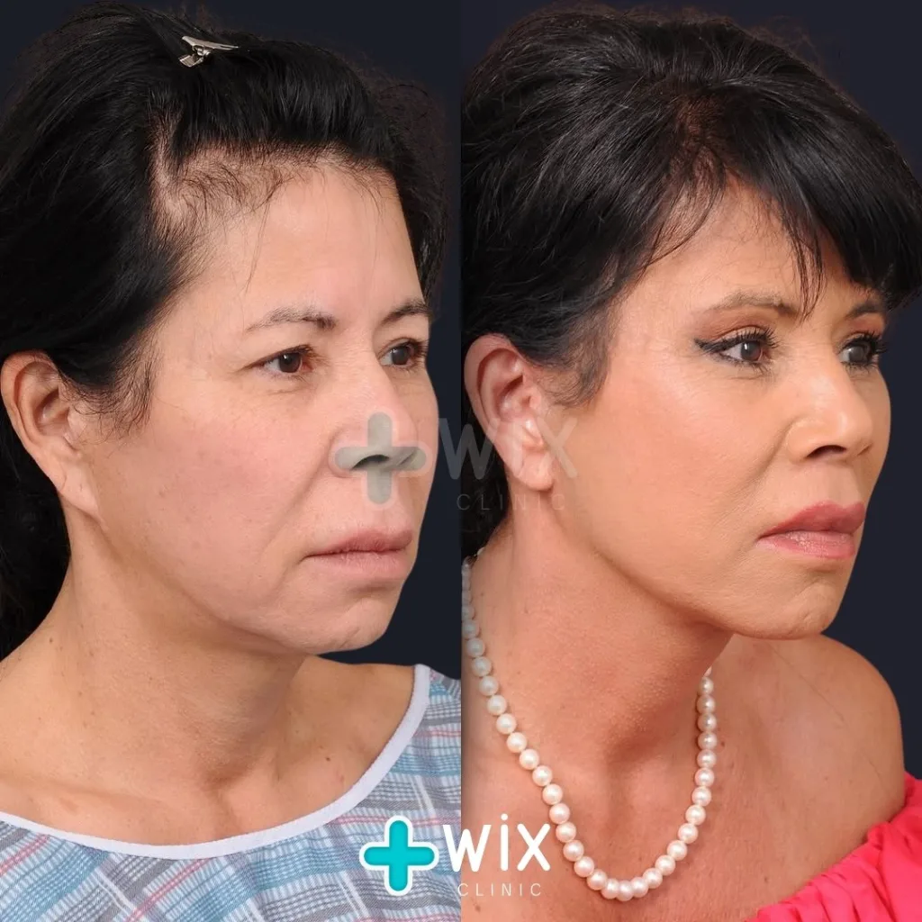 Necklift before and after