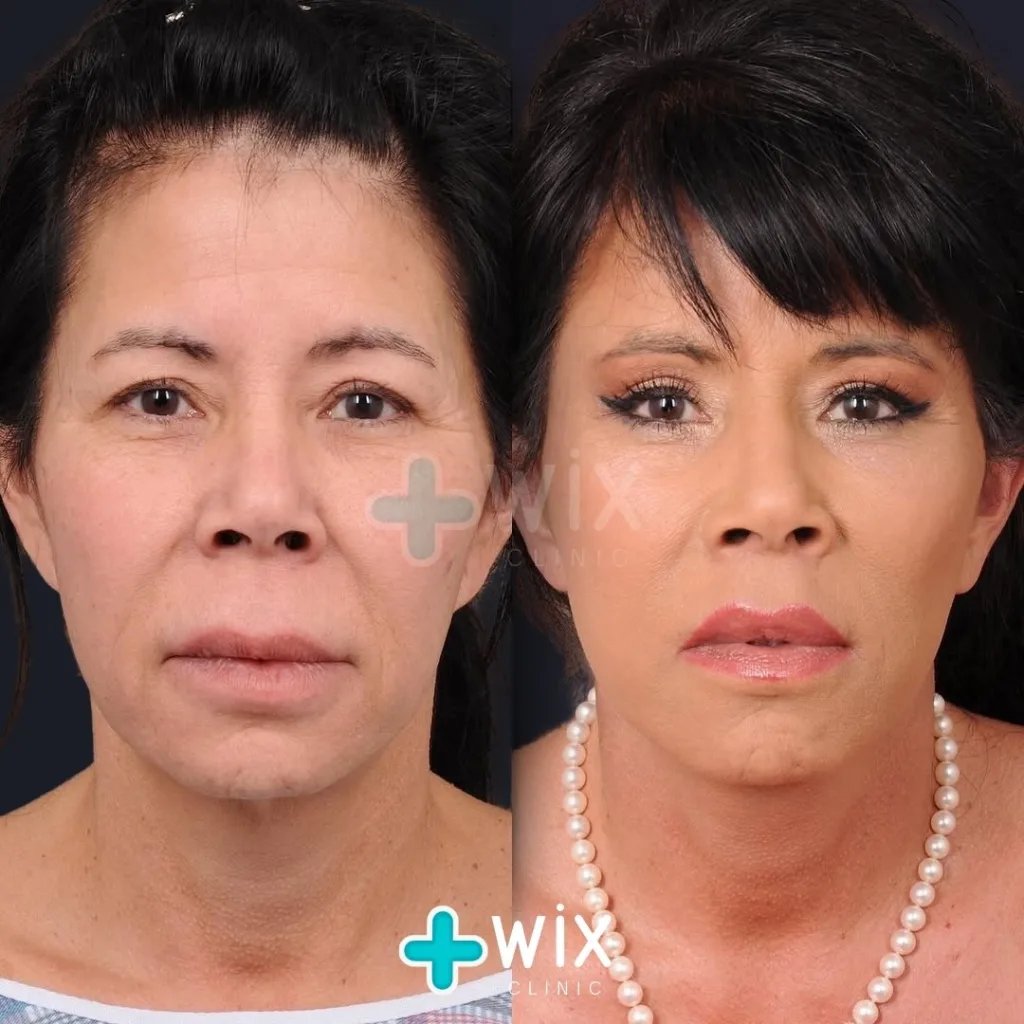 Necklift before and after