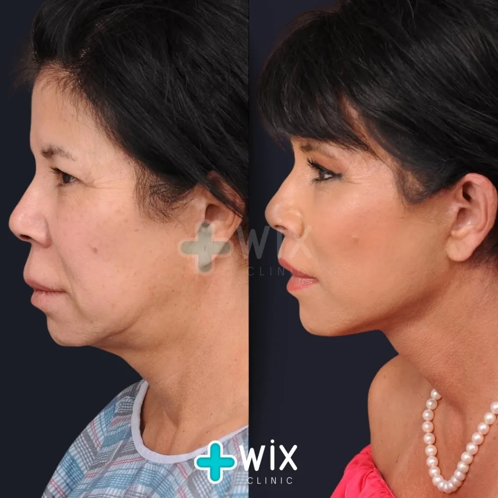 Necklift before and after