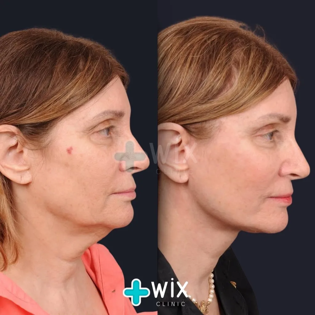 Necklift before and after