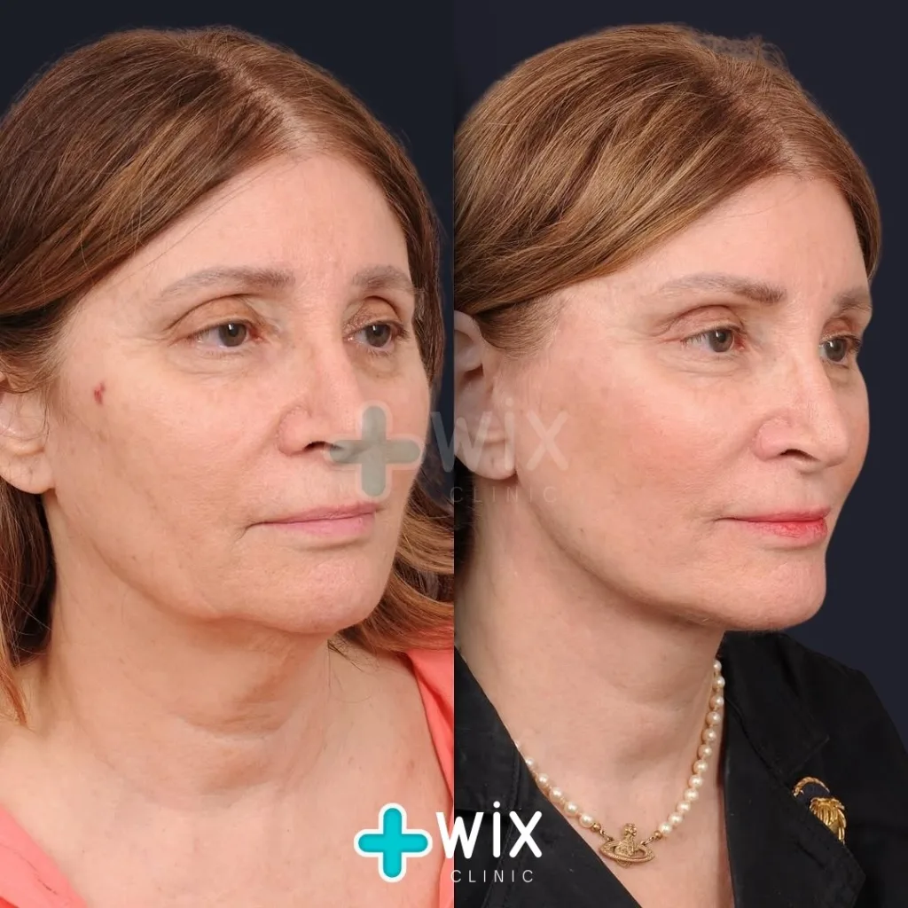 Necklift before and after