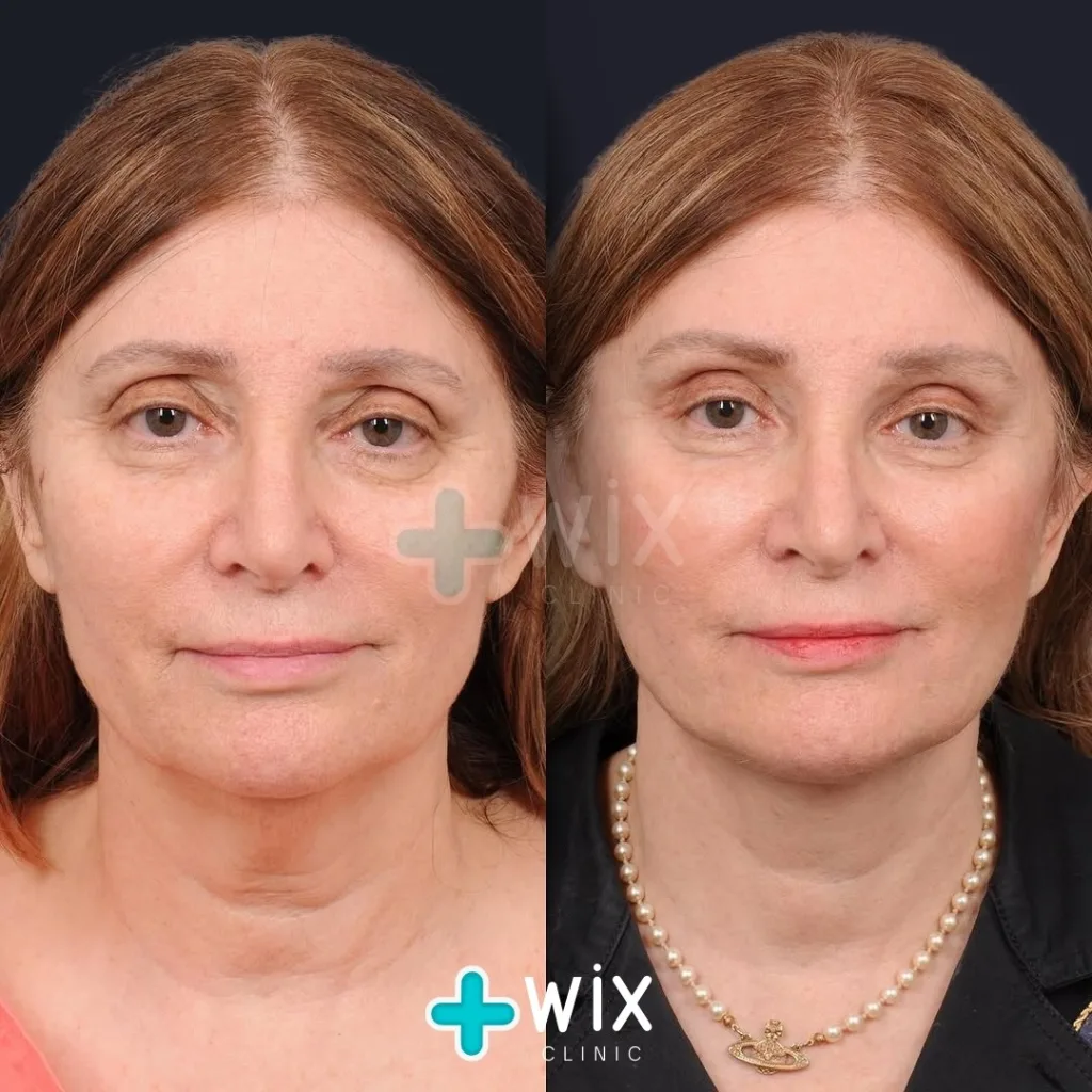 Necklift before and after