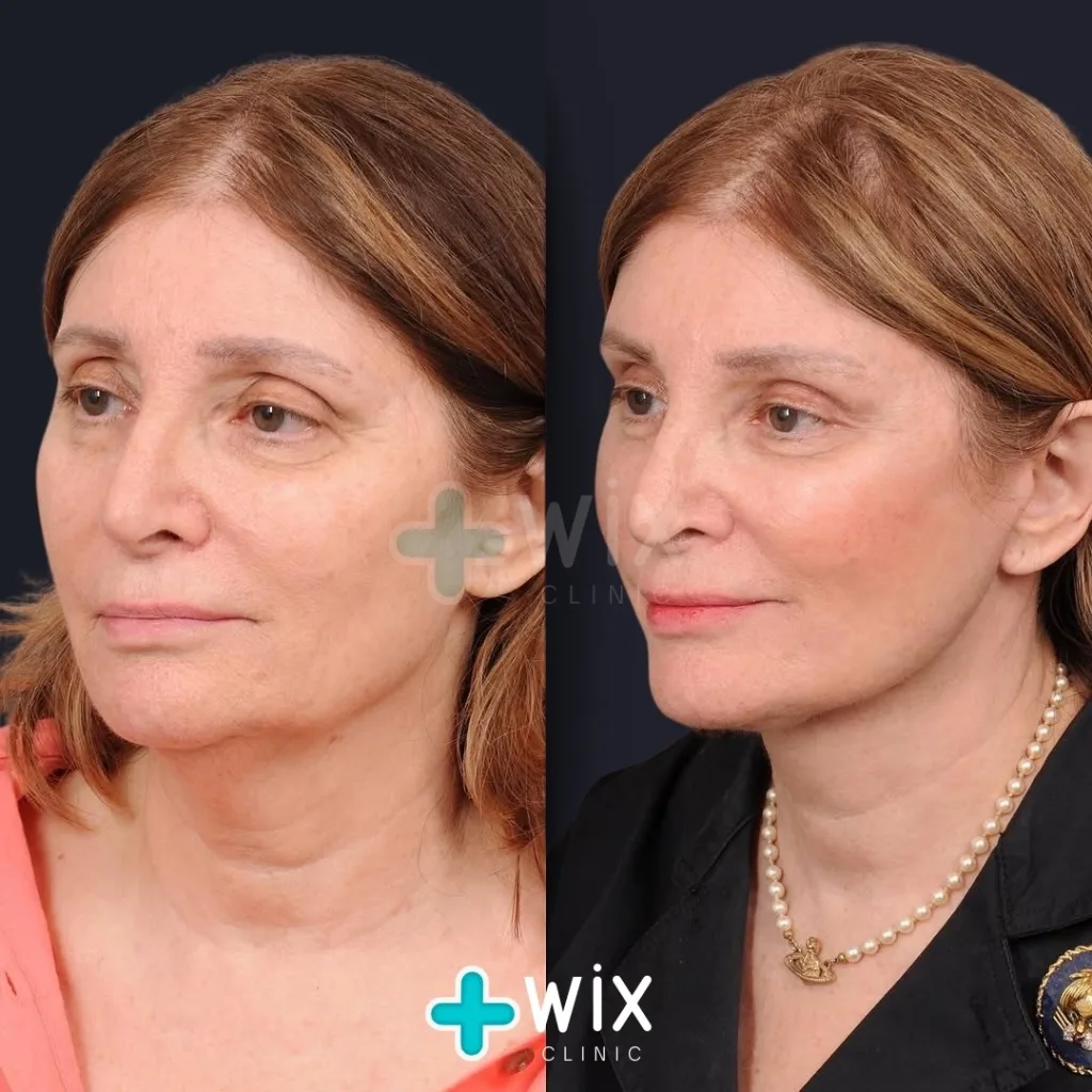 Necklift before and after