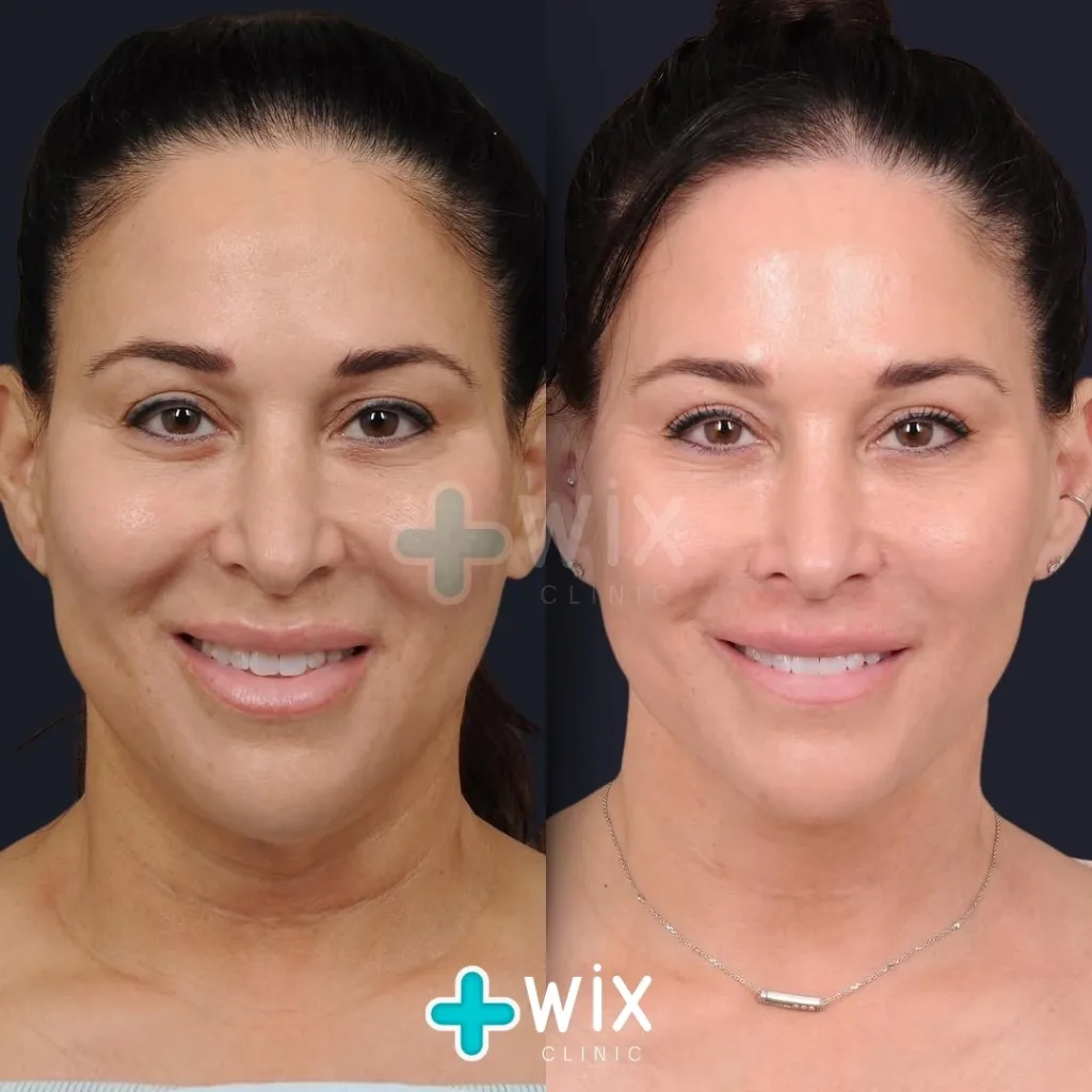 Necklift before and after