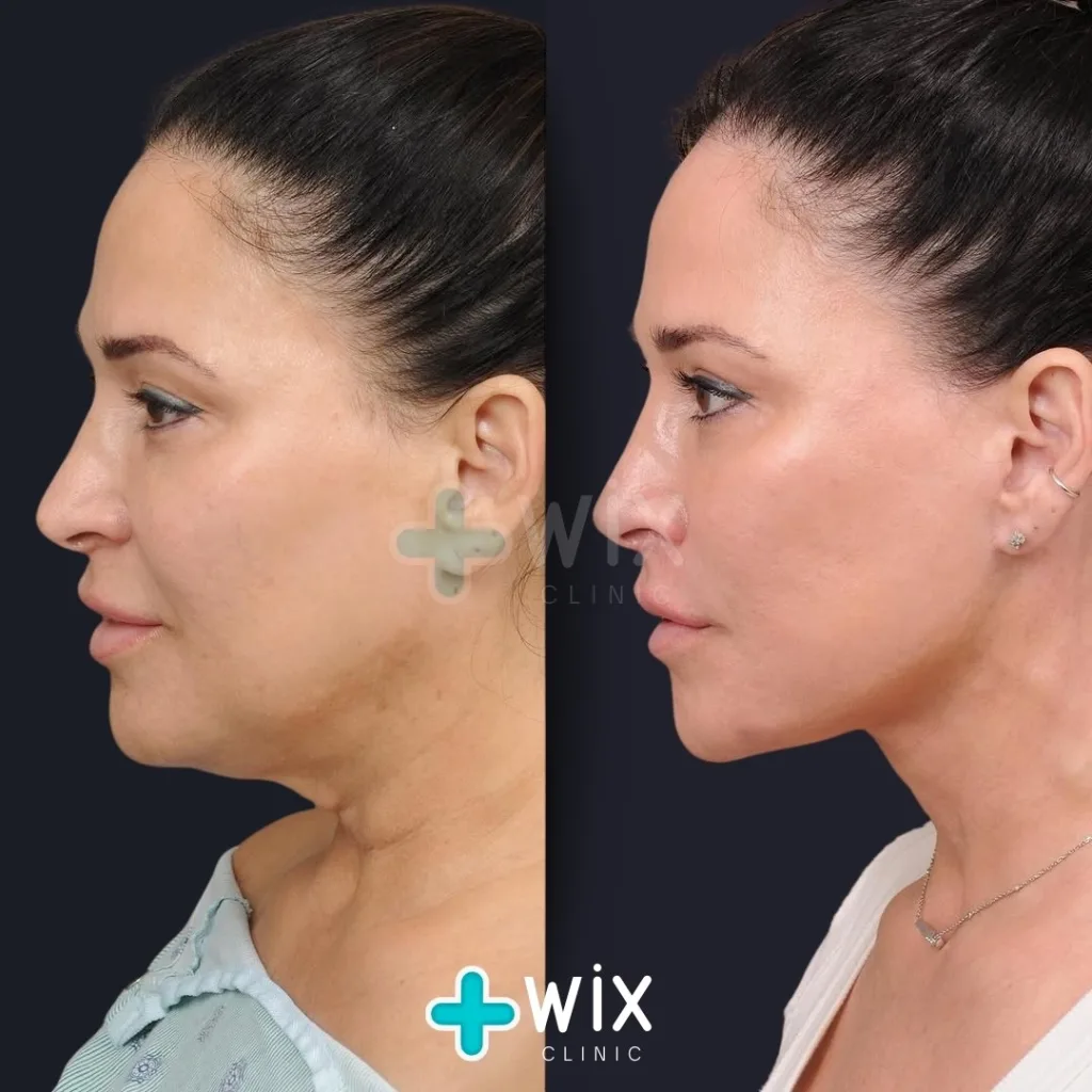 Necklift before and after