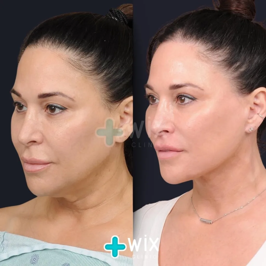 Necklift before and after