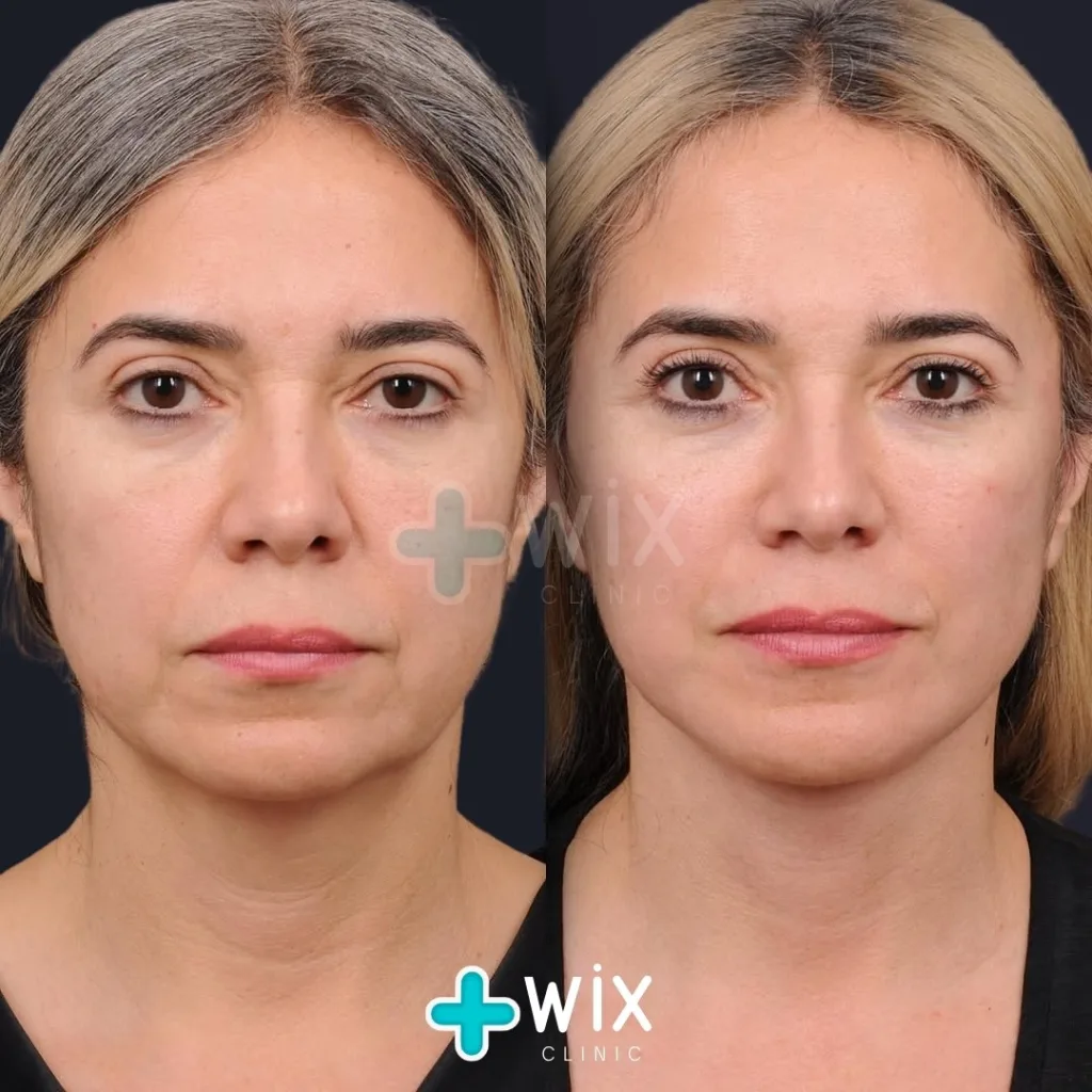 Necklift before and after