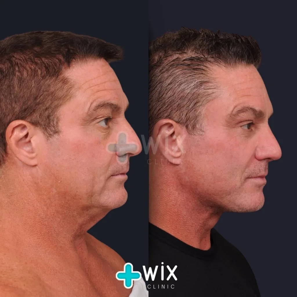 Necklift before and after