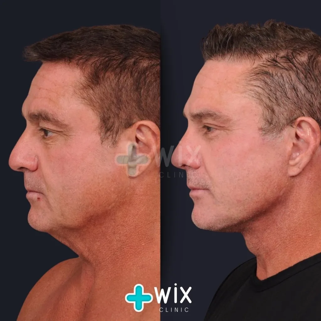 Necklift before and after