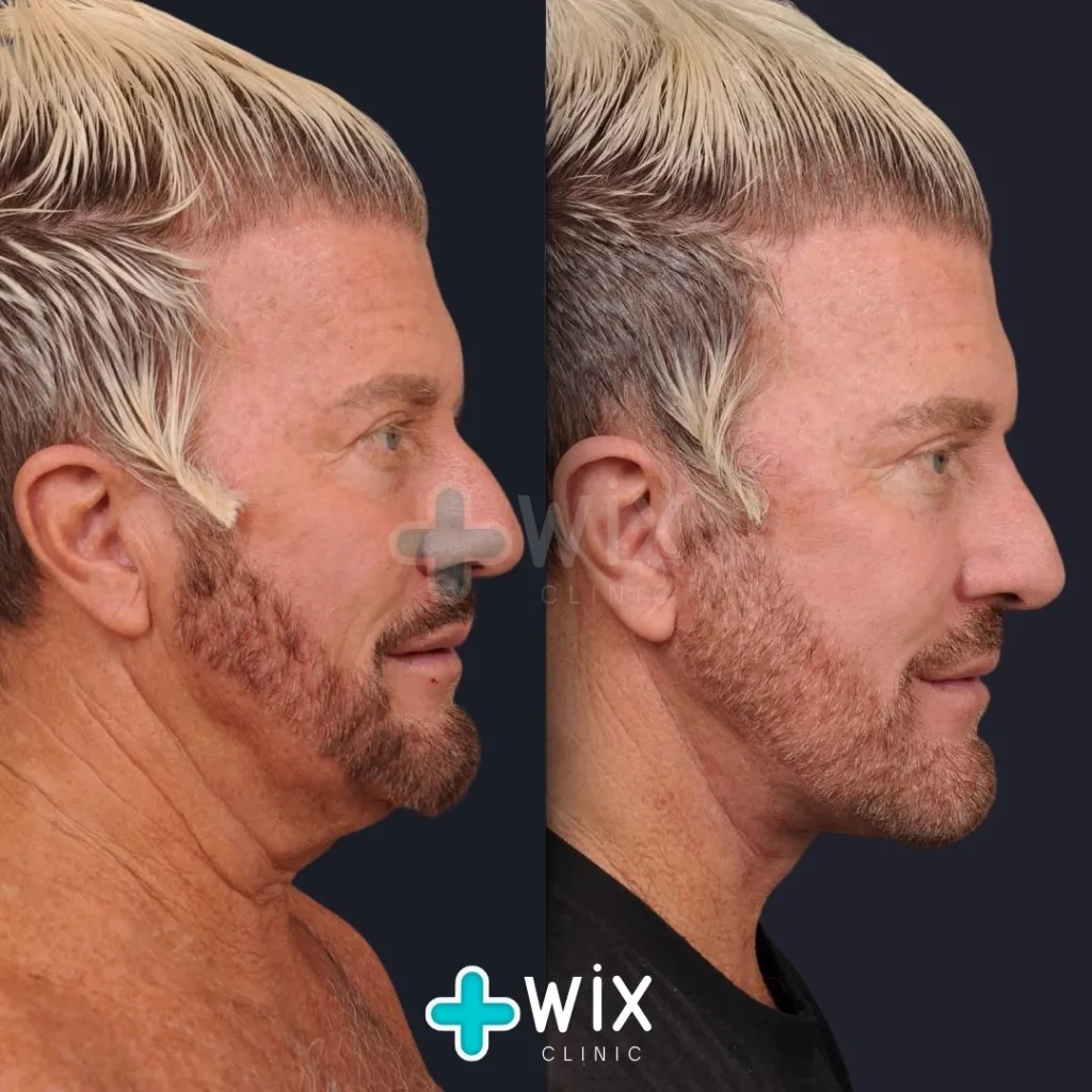 Necklift before and after