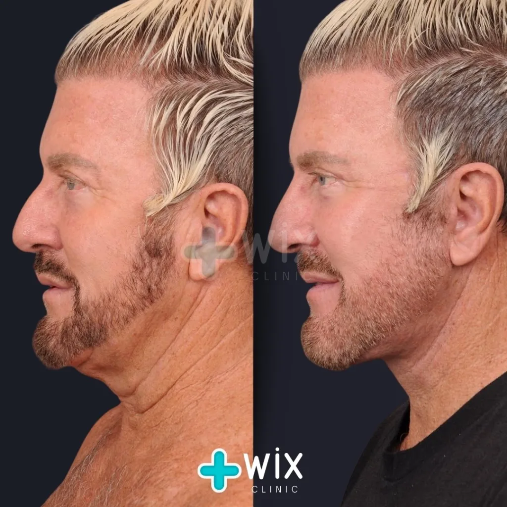 Necklift before and after