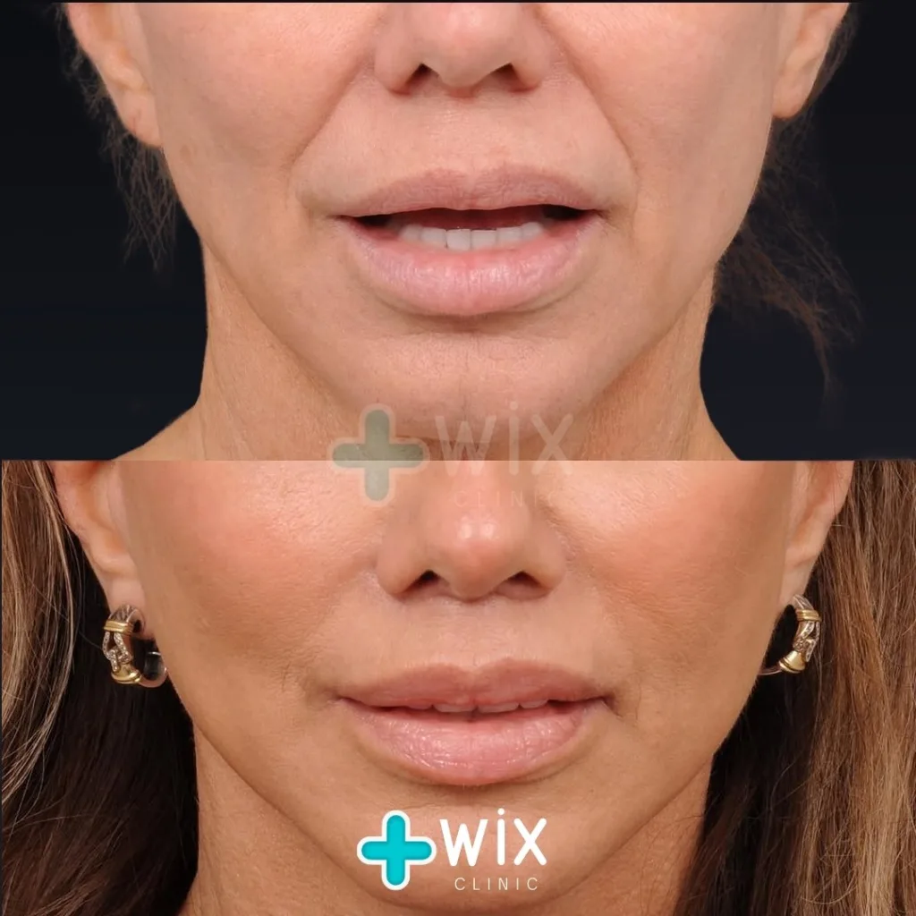 Necklift before and after