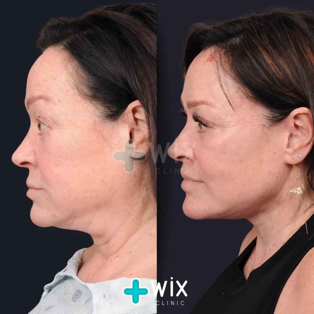 Necklift before and after