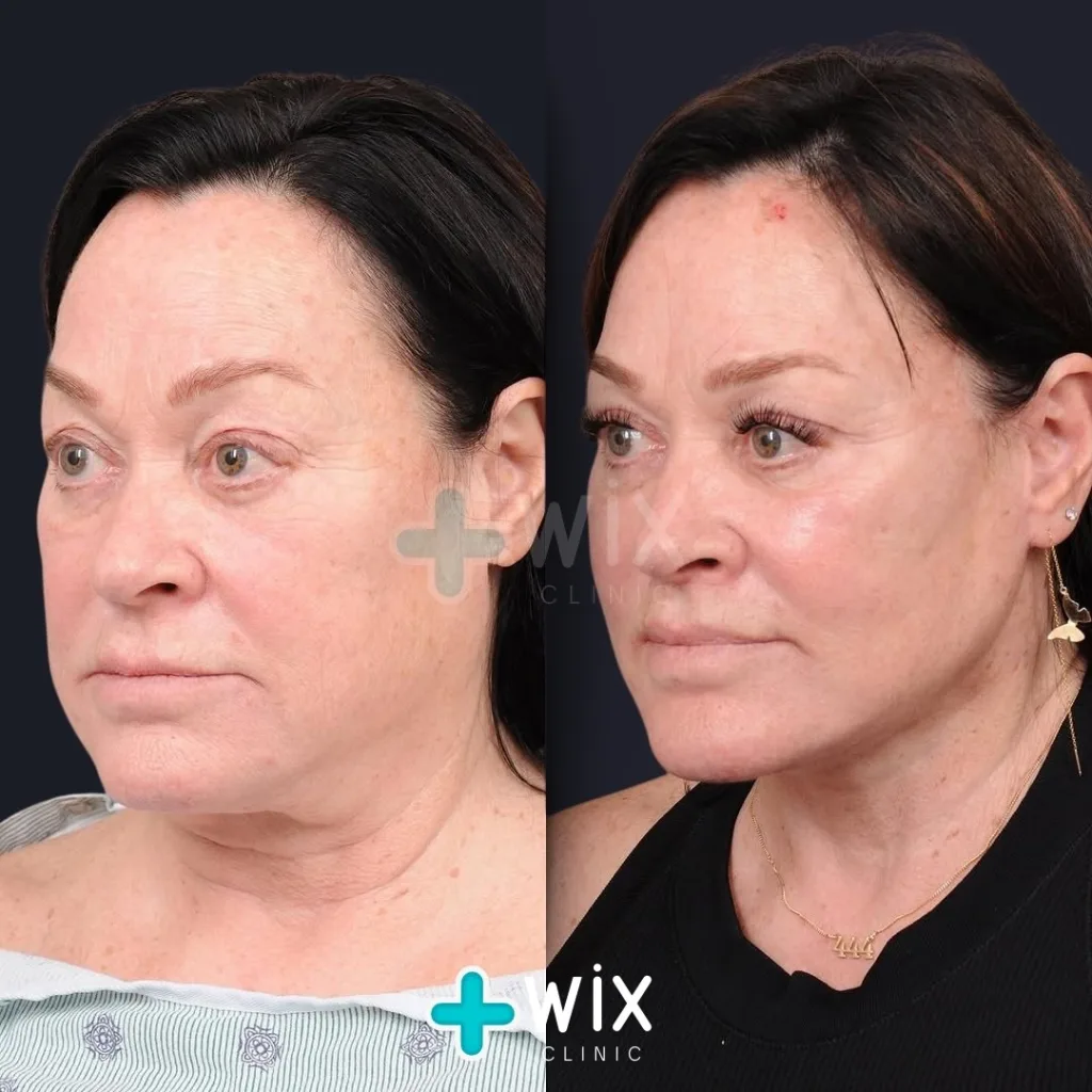 Necklift before and after