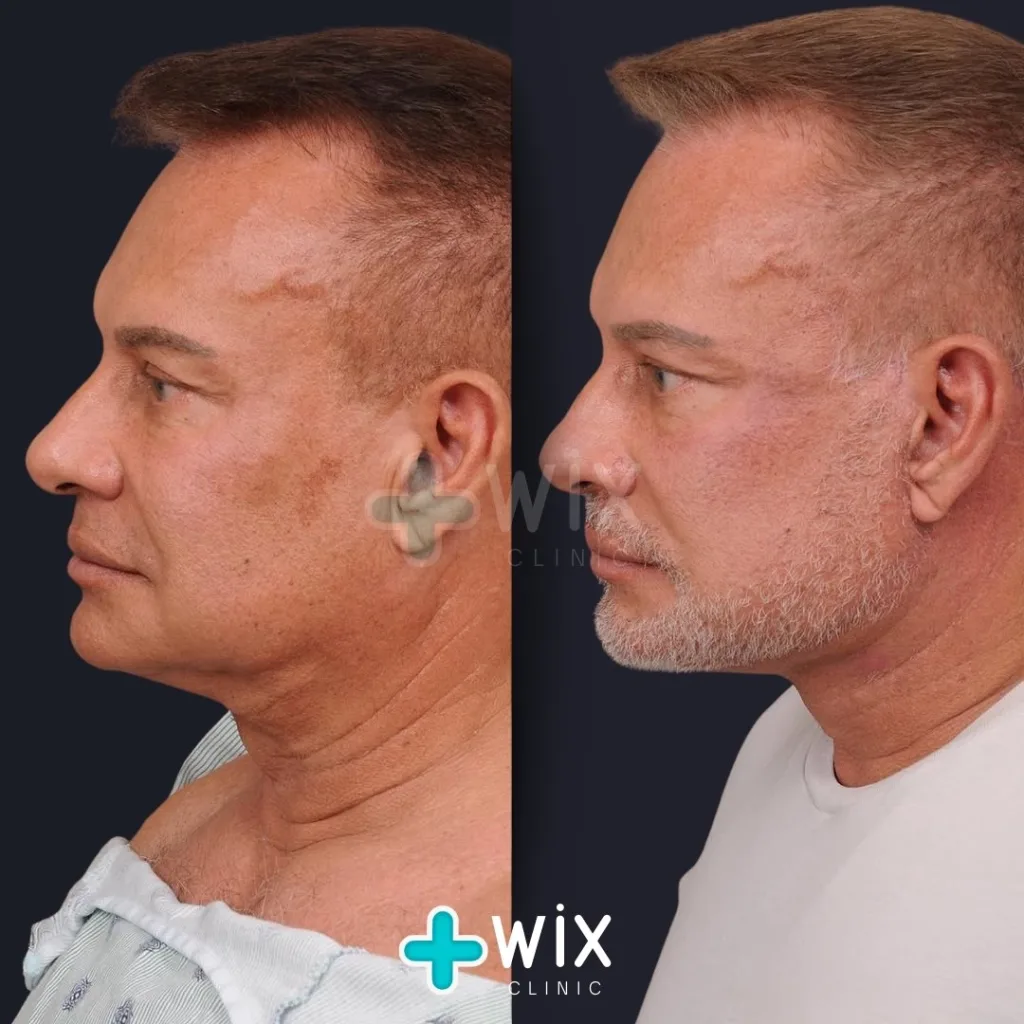 Necklift before and after