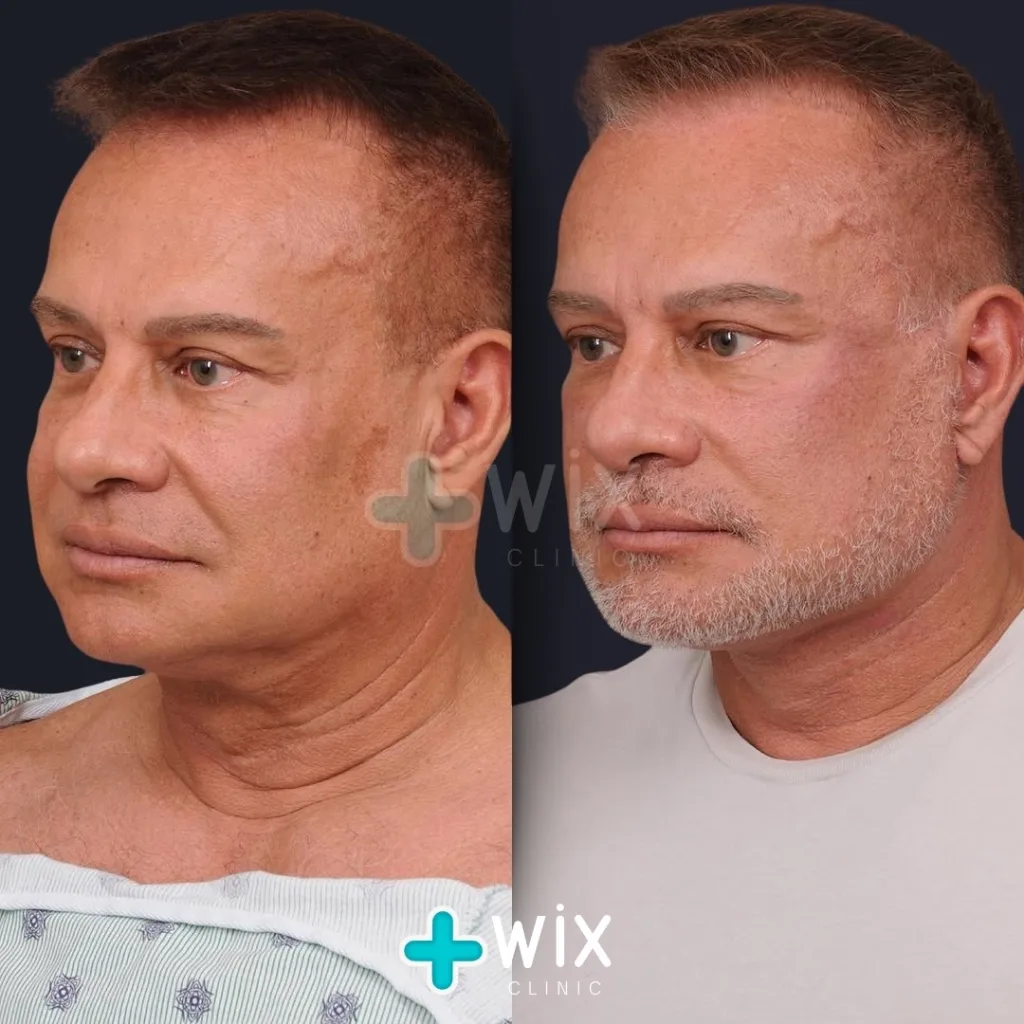 Necklift before and after