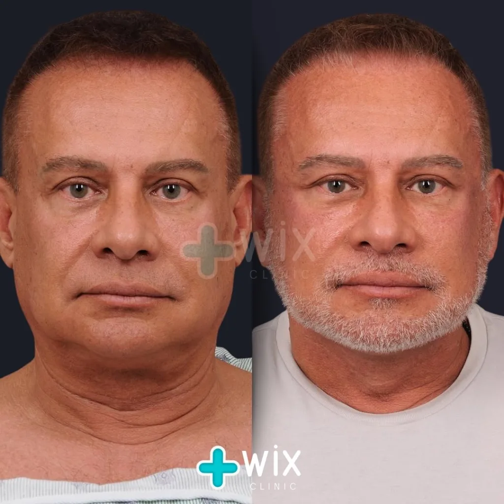 Necklift before and after