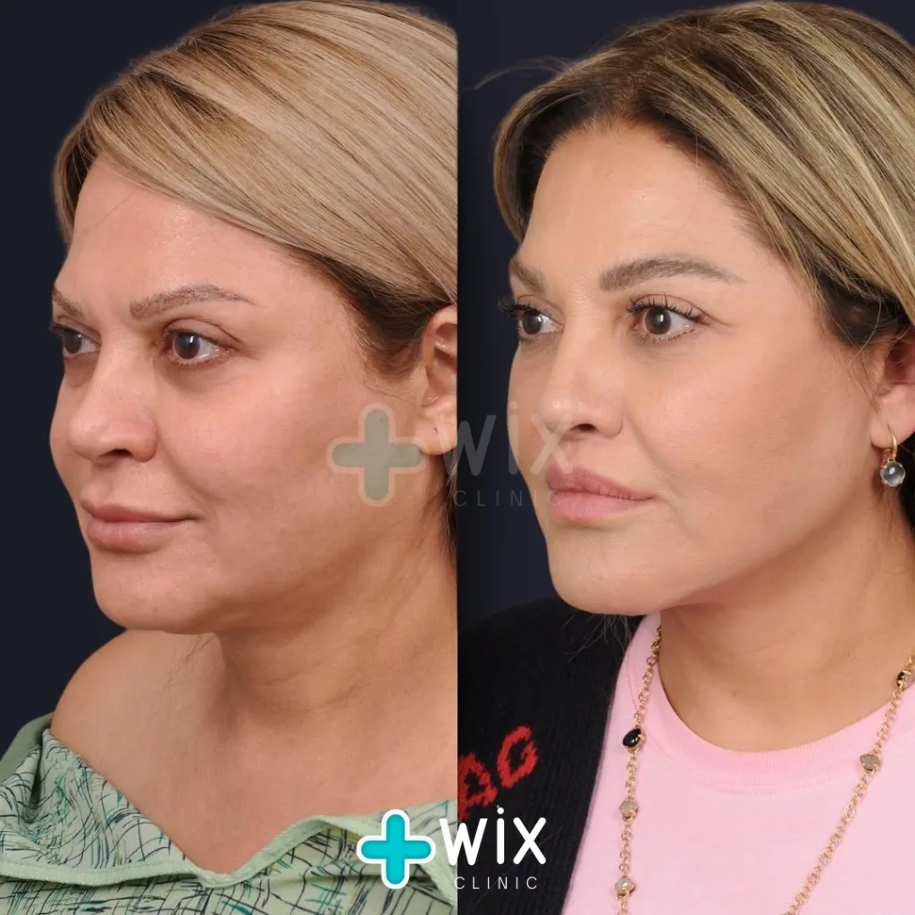 Necklift before and after