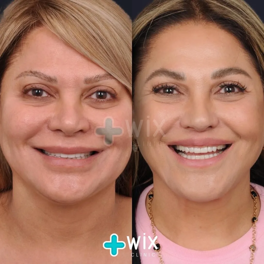 Necklift before and after