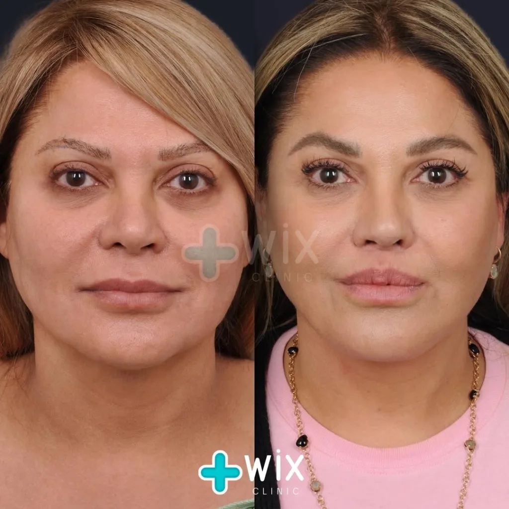 Necklift before and after