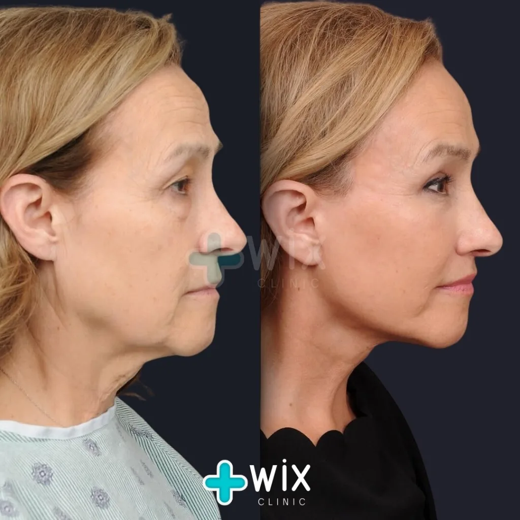 Necklift before and after